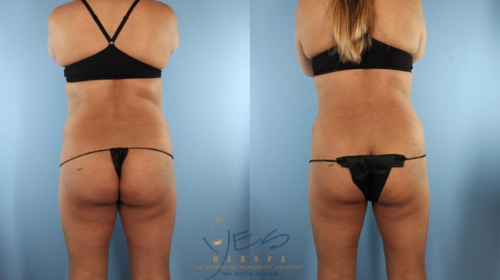 Before & After Tummy Tuck Case 524 Back View in Vancouver, BC