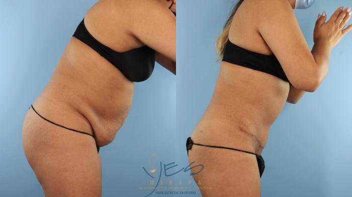 Before & After Tummy Tuck Case 524 Diver's Pose View in Vancouver, BC