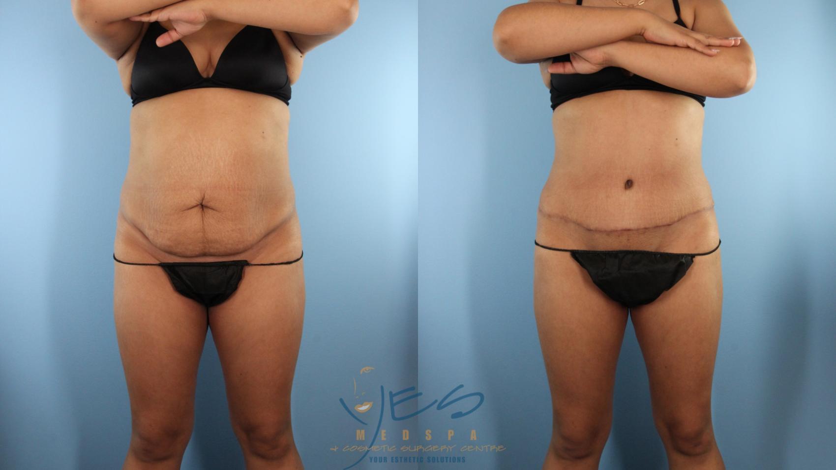 Before & After Tummy Tuck Case 524 Front View in Vancouver, BC