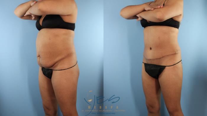 Before & After Tummy Tuck Case 524 Left Oblique View in Vancouver, BC