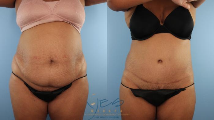 Before & After Tummy Tuck Case 531 Front View in Vancouver, BC