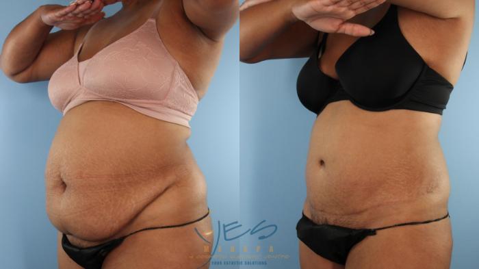 Before & After Tummy Tuck Case 531 Left Oblique View in Vancouver, BC