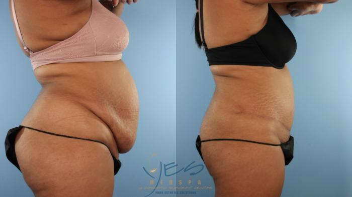 Before & After Tummy Tuck Case 531 Right Side View in Vancouver, BC