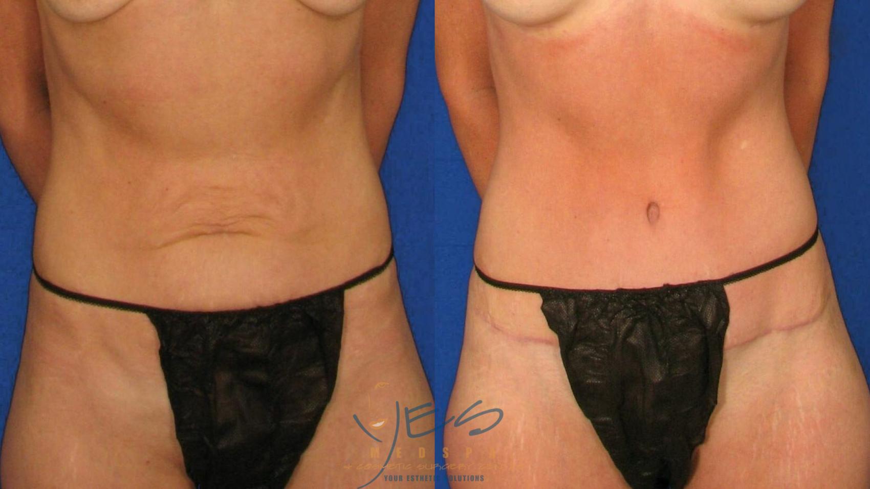 Before & After Tummy Tuck Case 55 Front View in Vancouver, BC