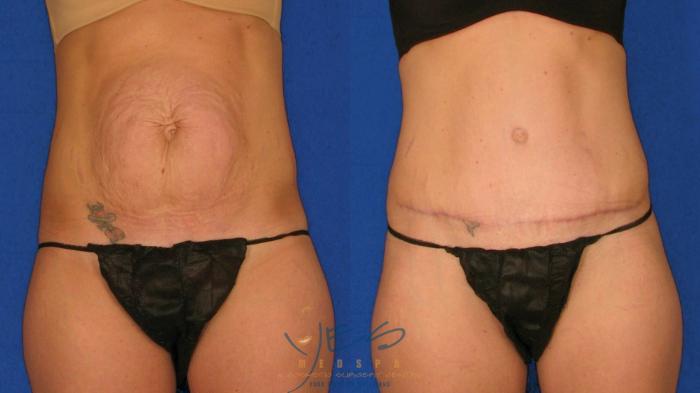 Before & After Tummy Tuck Case 57 Front View in Vancouver, BC