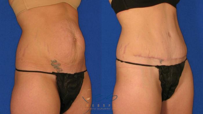 Before & After Tummy Tuck Case 57 Right Oblique View in Vancouver, BC