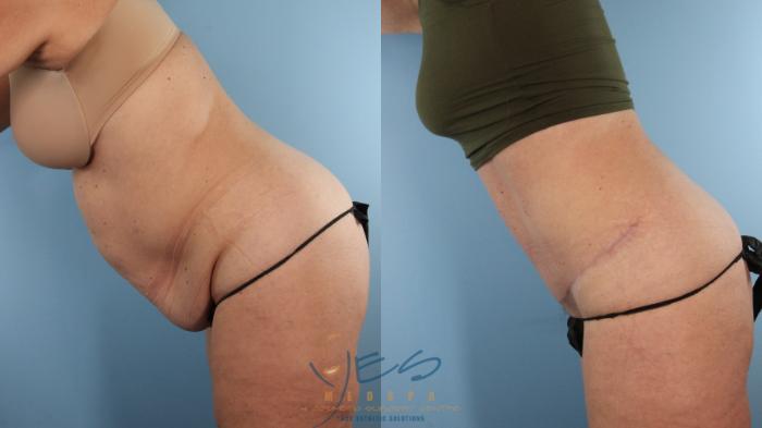 Before & After Tummy Tuck Case 581 Diver's Pose View in Vancouver, BC