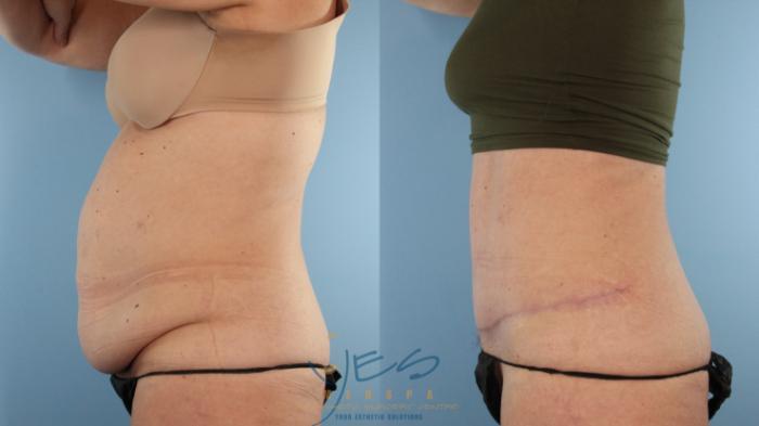 Before & After Tummy Tuck Case 581 Left Side View in Vancouver, BC