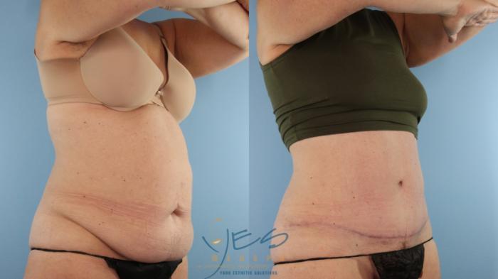 Before & After Tummy Tuck Case 581 Right Oblique View in Vancouver, BC