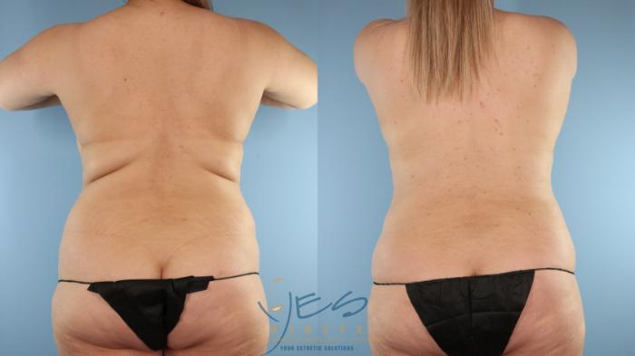 Before & After Tummy Tuck Case 585 Back View in Vancouver, BC