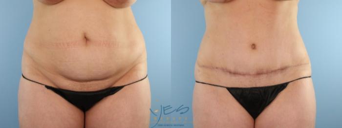 Before & After Tummy Tuck Case 585 Front View in Vancouver, BC