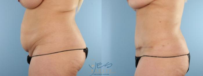 Before & After Tummy Tuck Case 585 Left Side View in Vancouver, BC