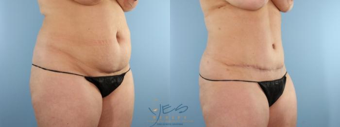 Before & After Tummy Tuck Case 585 Right Oblique View in Vancouver, BC