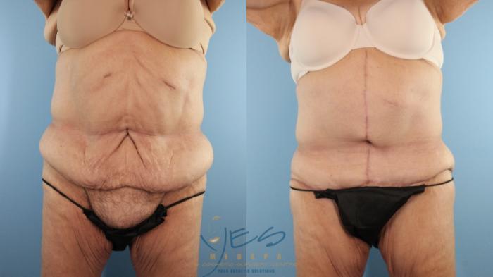 Before & After Tummy Tuck Case 596 Front View in Vancouver, BC