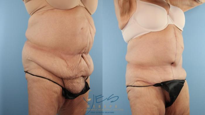Before & After Tummy Tuck Case 596 Right Oblique View in Vancouver, BC