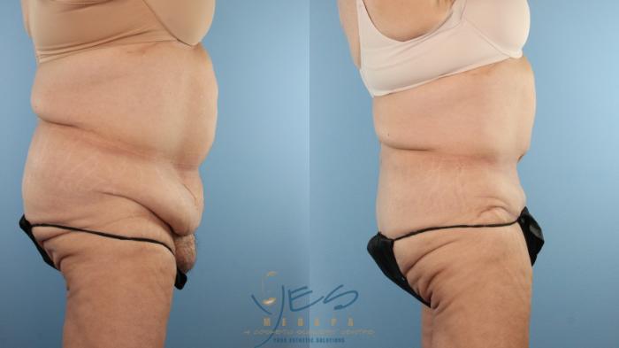 Before & After Tummy Tuck Case 596 Right Side View in Vancouver, BC