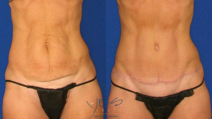 Before & After Tummy Tuck Case 65 Front View in Vancouver, BC