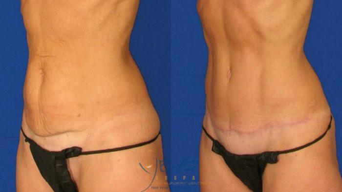 Before & After Tummy Tuck Case 65 Left Oblique View in Vancouver, BC