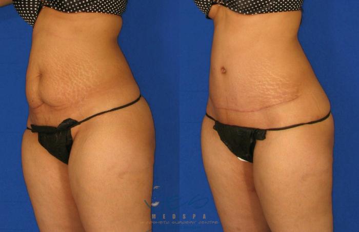 Before & After Tummy Tuck Case 90 View #2 View in Vancouver, BC