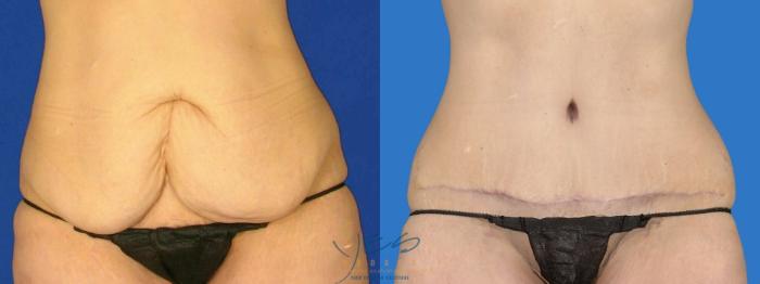 Before & After Tummy Tuck Case 94 Front View in Vancouver, BC