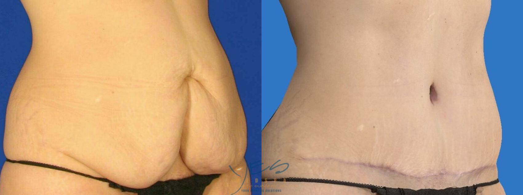 Before & After Tummy Tuck Case 94 Right Oblique View in Vancouver, BC