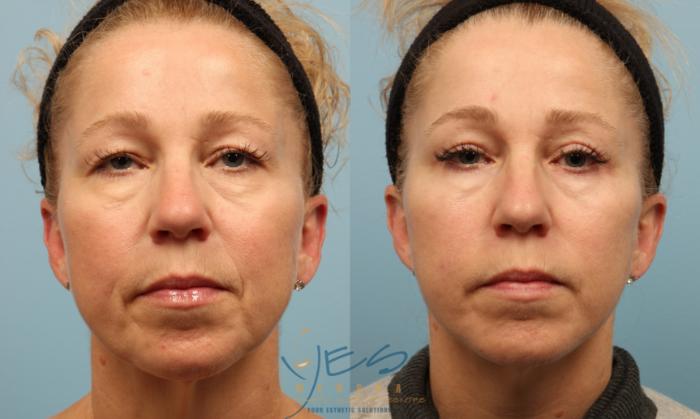 Before & After Face Fat Grafting Case 275 Front View in Vancouver, BC