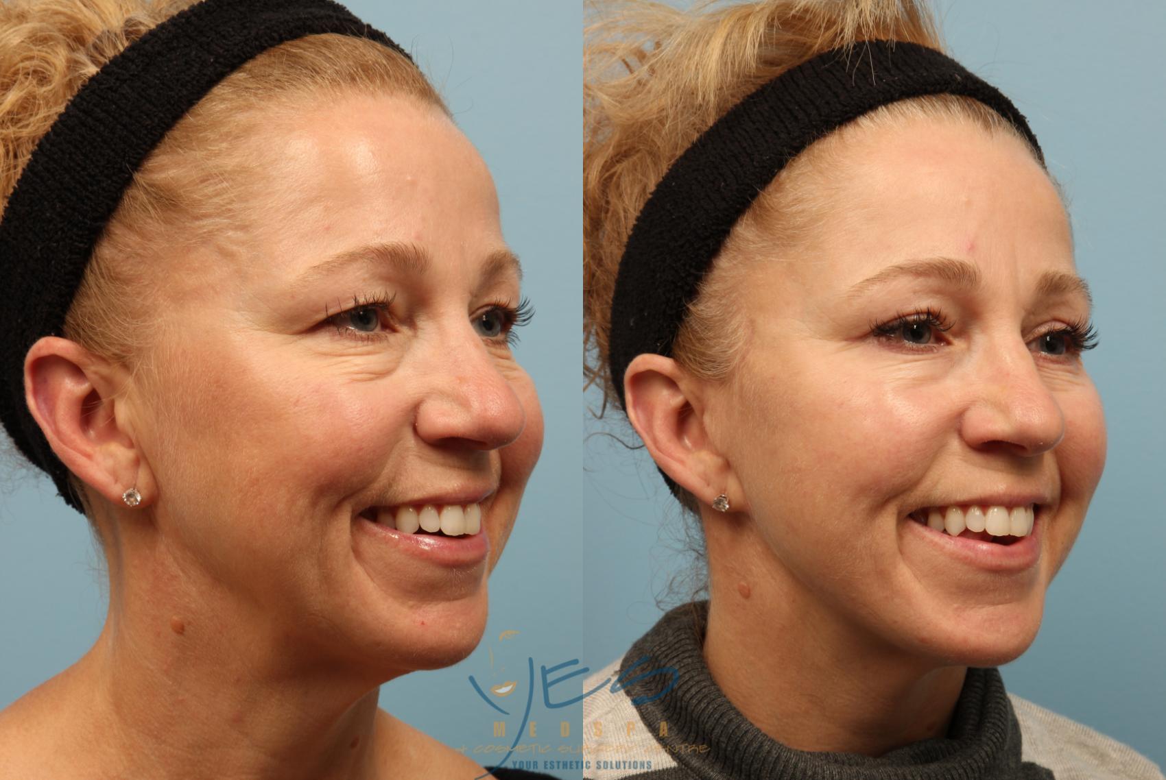 Face Fat Grafting Before & After Photos Patient 275 | Langley, BC | YES