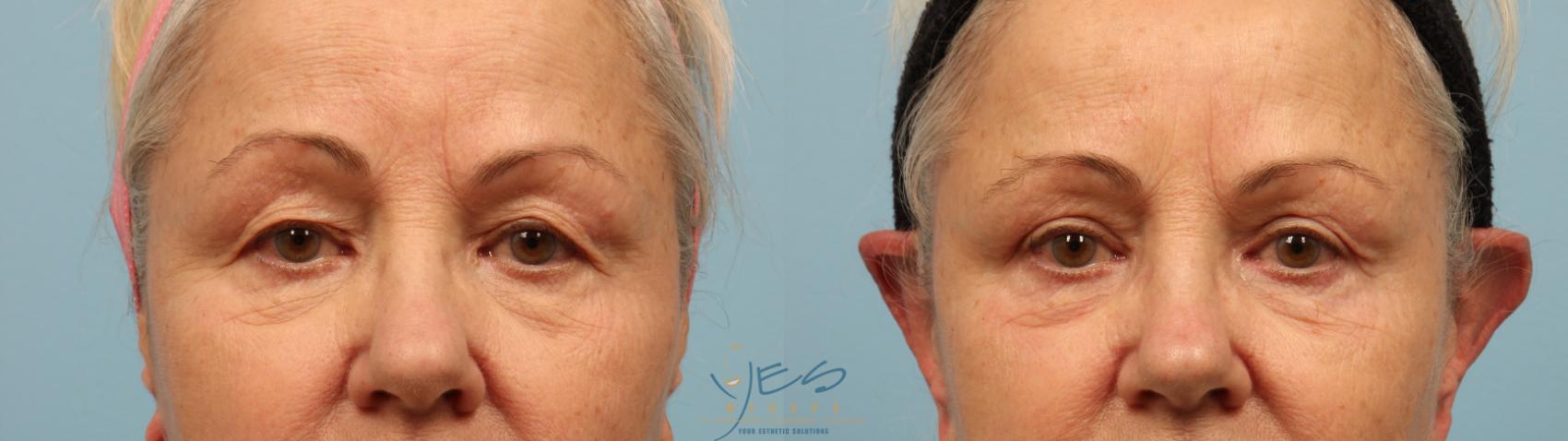 Before & After Upper Eyelid Blepharoplasty Case 294 Front View in Vancouver, BC