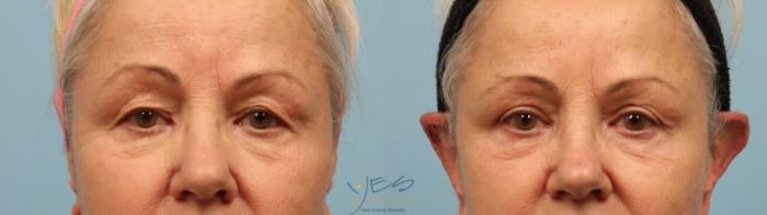 Before & After Upper Eyelid Blepharoplasty Case 294 Front View in Vancouver, BC