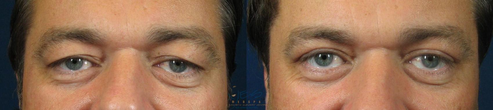 Before & After Upper Eyelid Blepharoplasty Case 42 View #1 View in Vancouver, BC