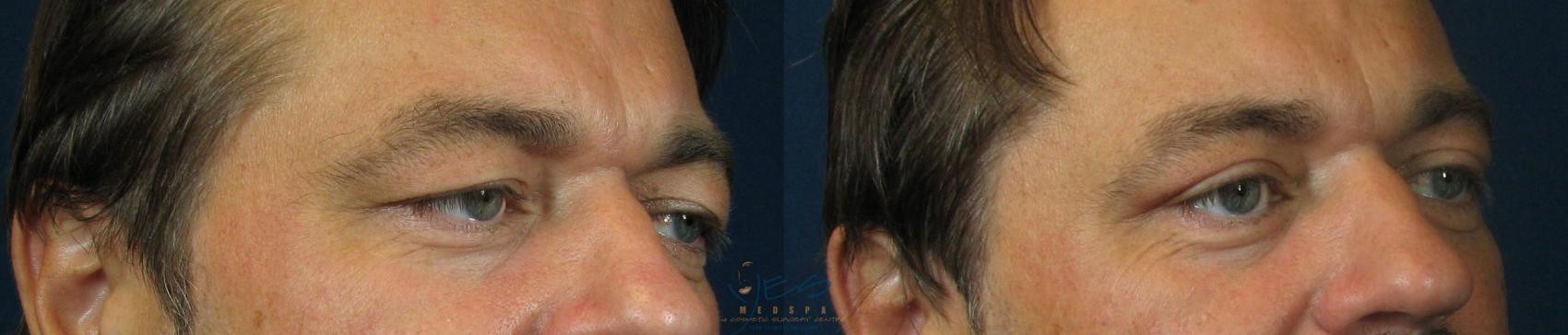 Before & After Upper Eyelid Blepharoplasty Case 42 View #2 View in Vancouver, BC