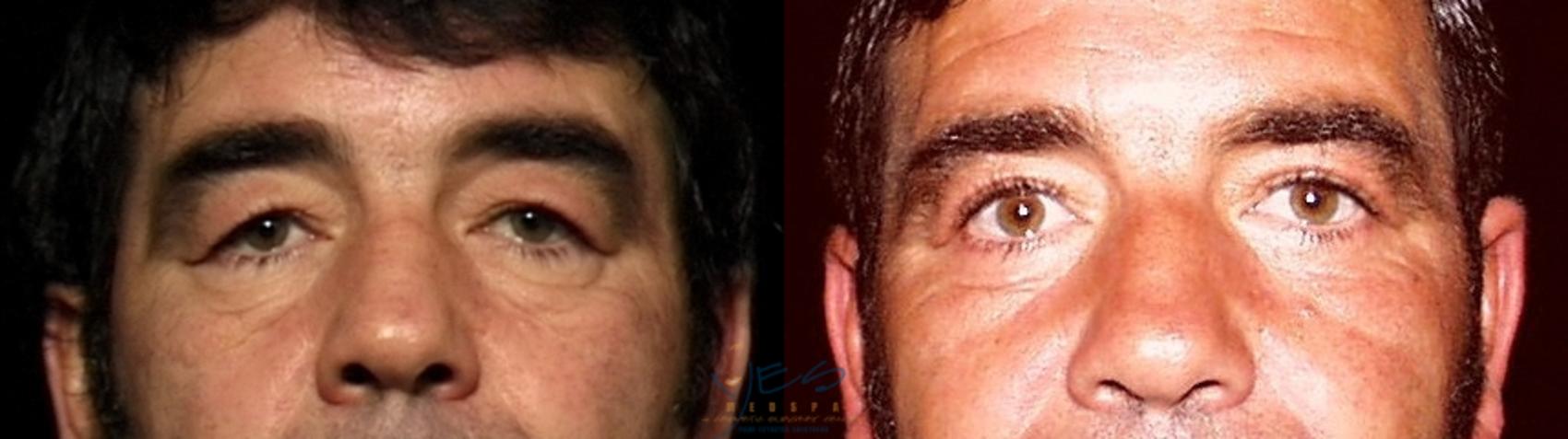 Before & After Upper Eyelid Blepharoplasty Case 44 View #1 View in Vancouver, BC