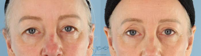 Before & After Upper Eyelid Blepharoplasty Case 467 Front View in Vancouver, BC