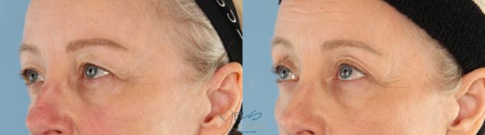 Before & After Upper Eyelid Blepharoplasty Case 467 Left Side View in Vancouver, BC