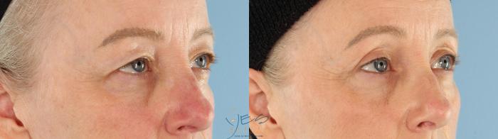 Before & After Upper Eyelid Blepharoplasty Case 467 Right Oblique View in Vancouver, BC