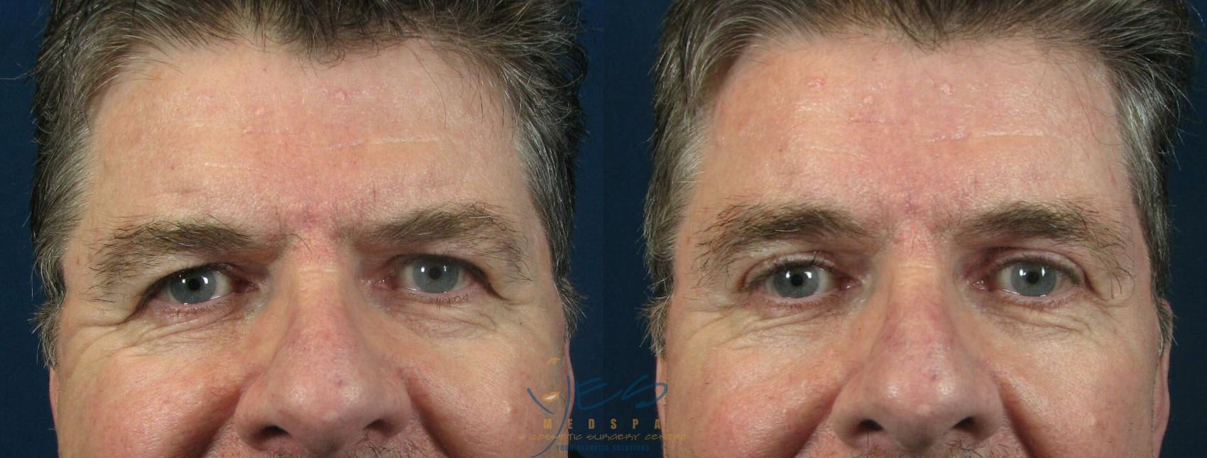 Before & After Upper Eyelid Blepharoplasty Case 58 View #1 View in Vancouver, BC