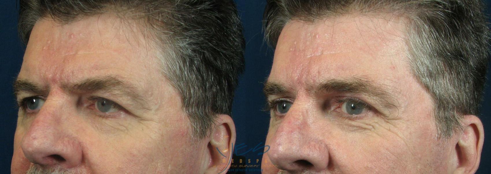 Before & After Upper Eyelid Blepharoplasty Case 58 View #2 View in Vancouver, BC