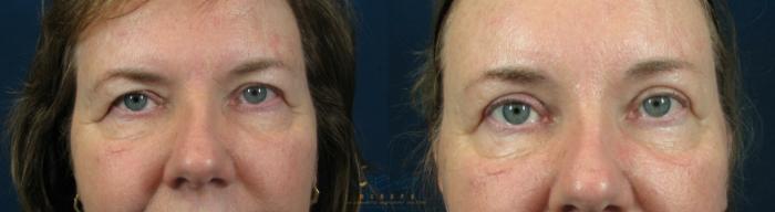 Before & After Upper Eyelid Blepharoplasty Case 59 View #1 View in Vancouver, BC