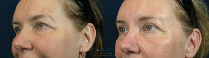 Before & After Upper Eyelid Blepharoplasty Case 59 View #2 View in Vancouver, BC