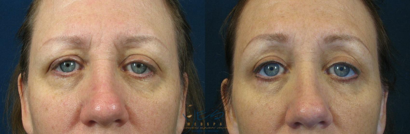 Before & After Upper Eyelid Blepharoplasty Case 60 View #1 View in Vancouver, BC