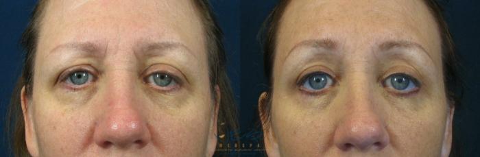 Before & After Upper Eyelid Blepharoplasty Case 60 View #1 View in Vancouver, BC