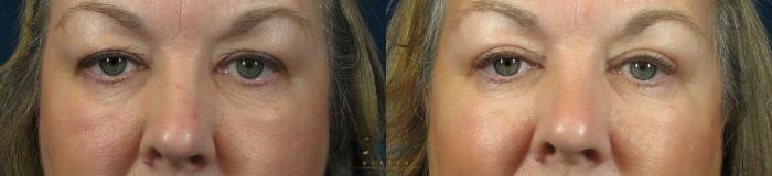 Before & After Upper Eyelid Blepharoplasty Case 62 View #1 View in Vancouver, BC
