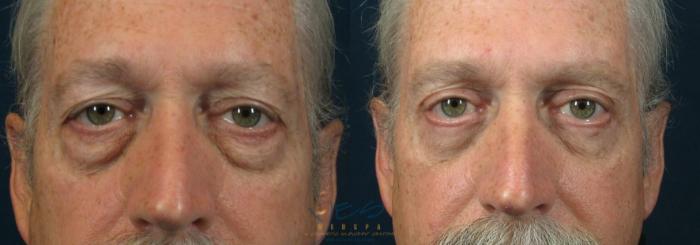 Before & After Upper Eyelid Blepharoplasty Case 89 View #1 View in Vancouver, BC