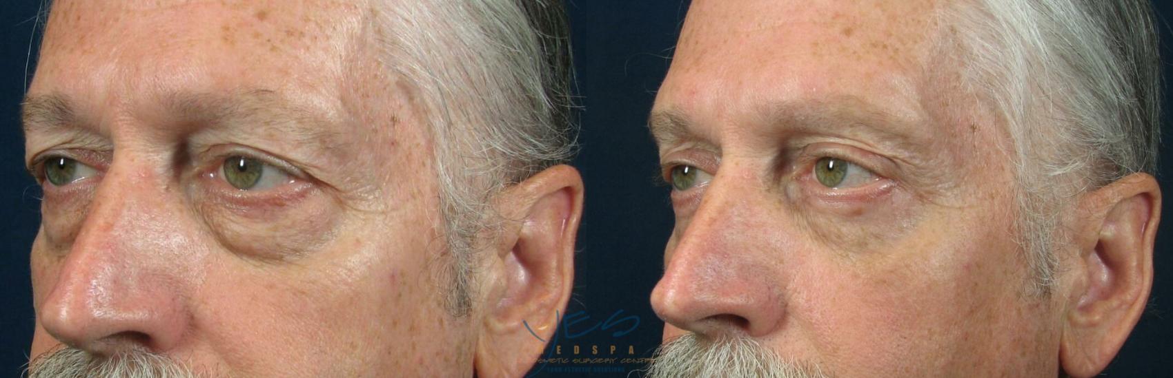 Upper Eyelid Blepharoplasty Before & After Photos Patient 89 | Langley