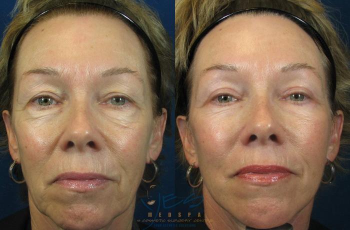 Before & After Upper & Lower Blepharoplasty Case 102 View #1 View in Vancouver, BC