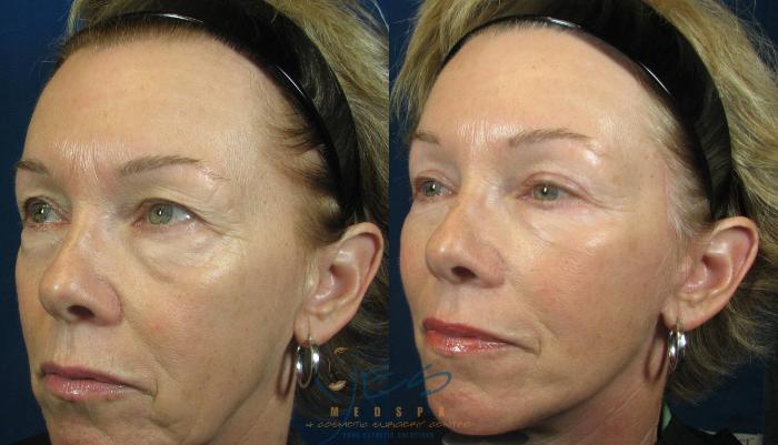 Before & After Upper & Lower Blepharoplasty Case 102 View #2 View in Vancouver, BC