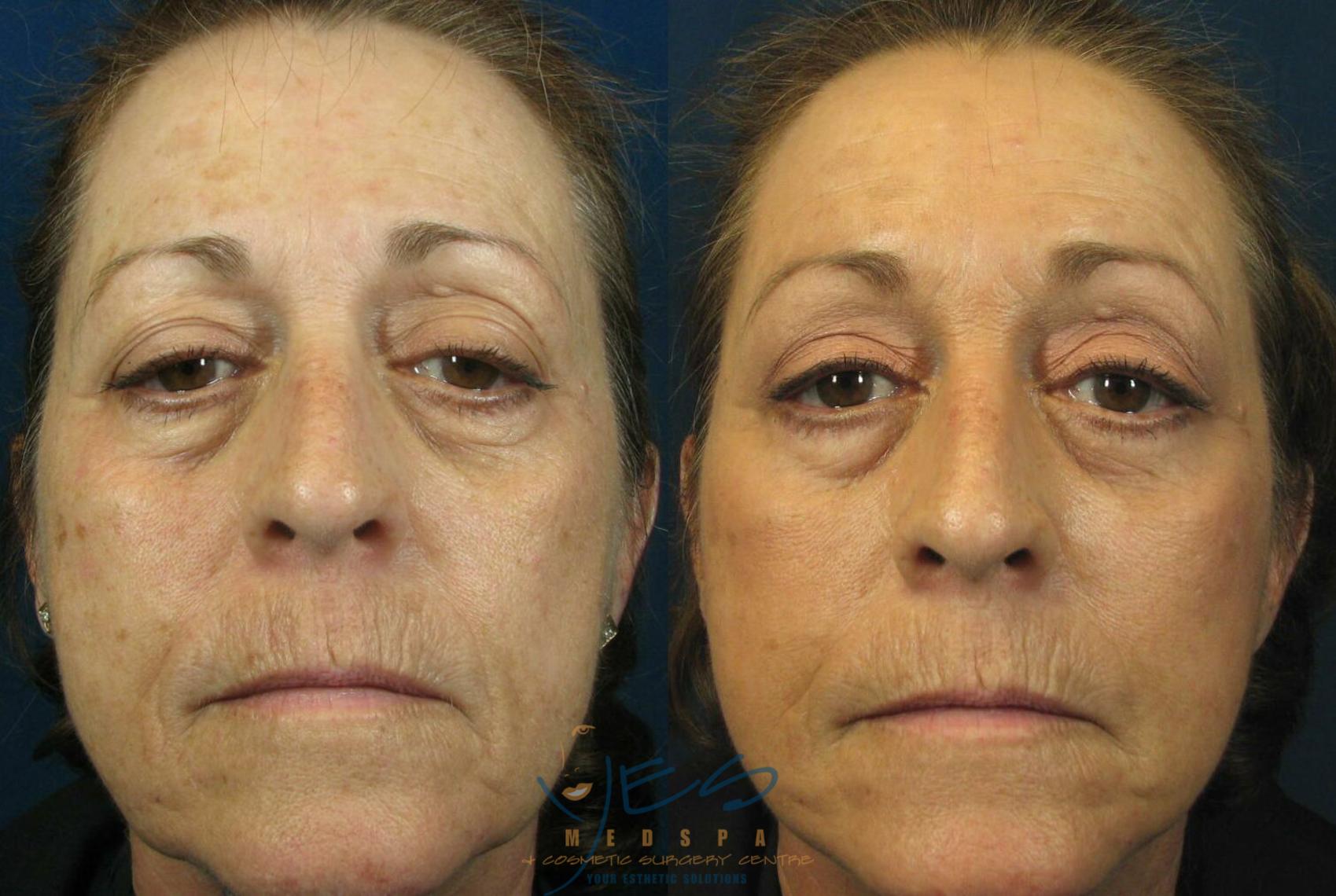 Before & After Upper & Lower Blepharoplasty Case 108 View #1 View in Vancouver, BC