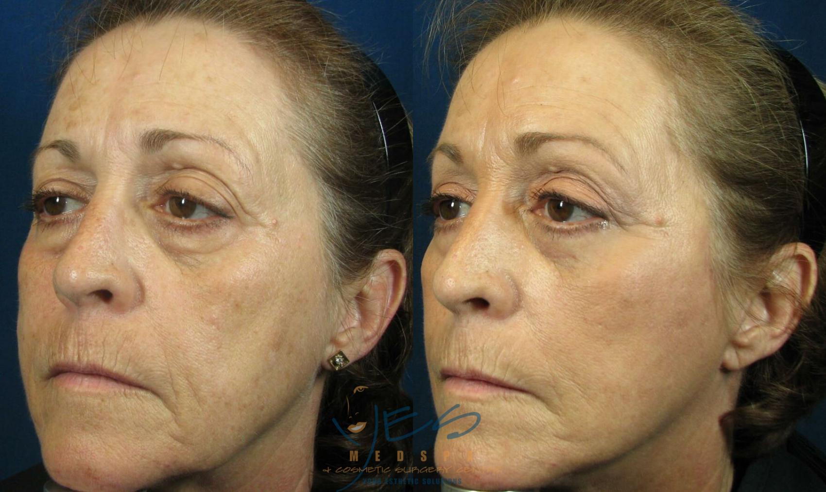 Before & After Upper & Lower Blepharoplasty Case 108 View #2 View in Vancouver, BC