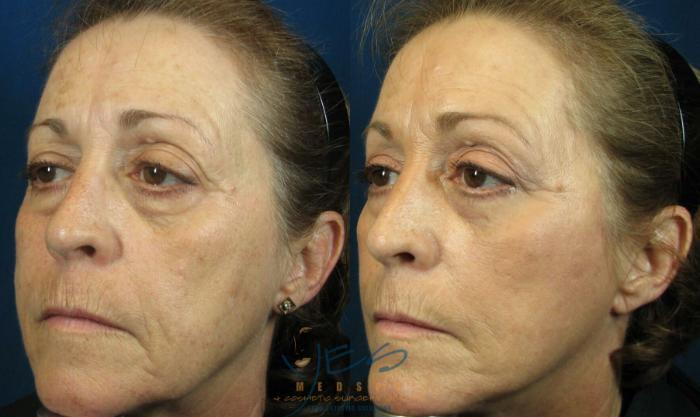 Before & After Upper & Lower Blepharoplasty Case 108 View #2 View in Vancouver, BC