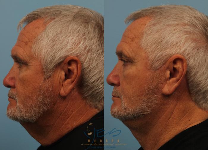 Before & After Upper & Lower Blepharoplasty Case 190 View #2 View in Vancouver, BC